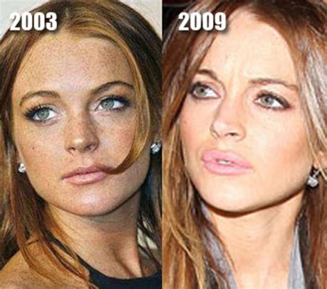 Celebrity Plastic Surgery Before After 56 Pics Picture 41