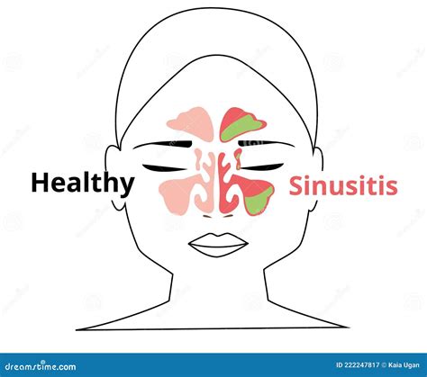 Sinusitis Healthy And Inflammation Nasal Sinus Vector Illustration