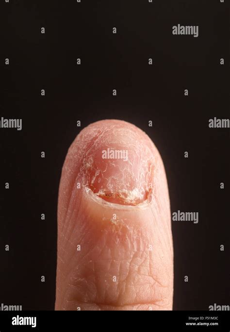 Missing Finger Hi Res Stock Photography And Images Alamy