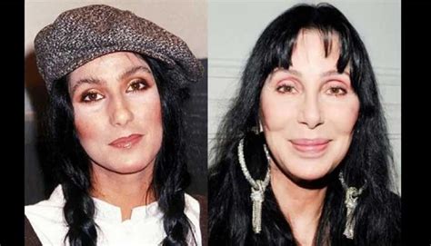 Cher Plastic Surgery Breasts Augmentation Nose Job Facelift