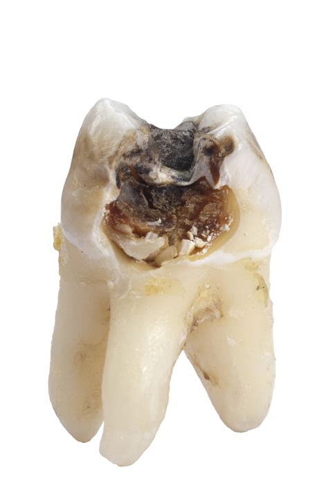 Broken Wisdom Tooth Extraction Cost