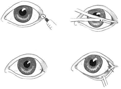 Ocular Trauma 2018 10 04