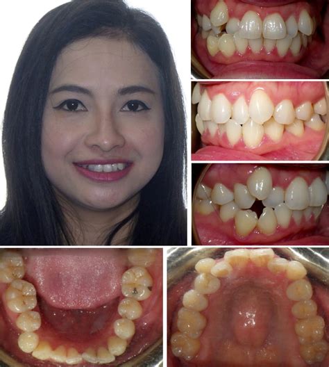 Teeth Before And After Braces Crowding