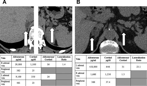 Adrenal Imaging In Patients With Endocrine Hypertension Endocrinology