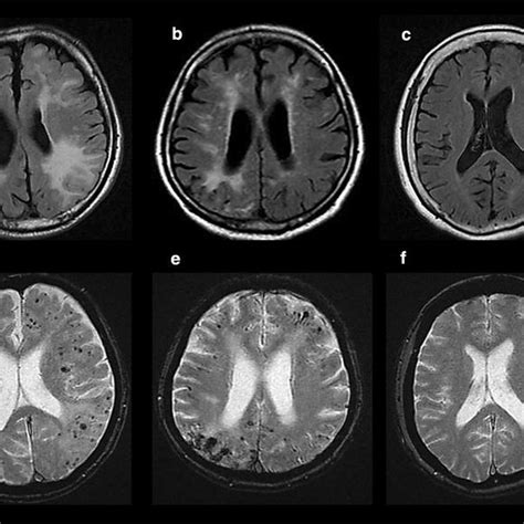 Evaluation Of Brain Mri Findings Of Ad And Mci Patients Ad Alzheimers