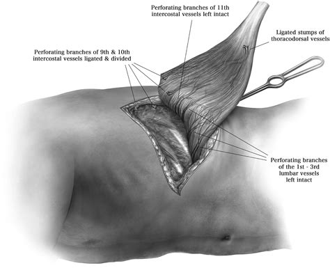 Latissimus Dorsi Muscle Flap With A Distally Based Serratus My XXX