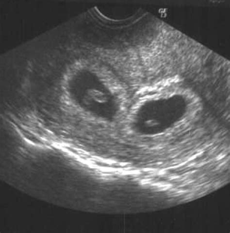 Transvaginal Ultrasound Demonstrating Viability Of Twin Pregnancy At 8