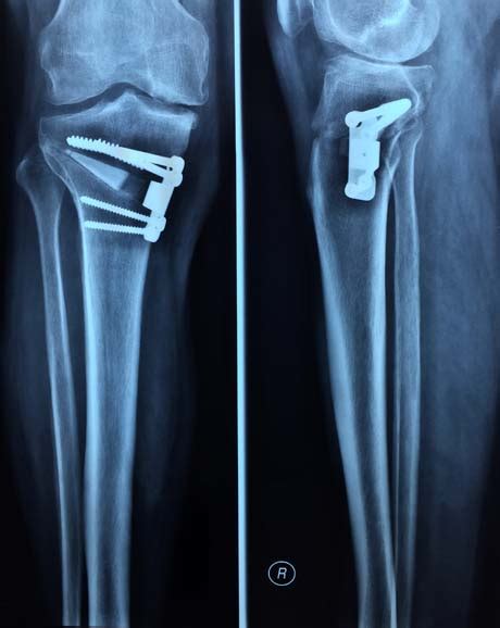 Varus Knee Osteoarthritis Corrective Tibial Osteotomy George D