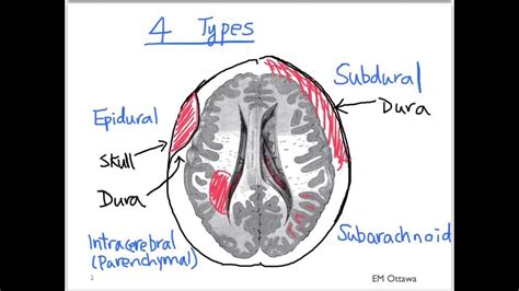 Hematoma is suspected in patients with symptoms and signs of acute, nontraumatic spinal cord compression or sudden, unexplained lower extremity paresis, particularly if a possible cause (eg, trauma, bleeding diathesis) is. subdural, epidural brain - Google Search | Hemorrhage ...