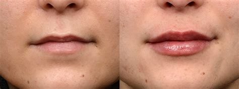 Lip Enhancement Before And After Dr Jeffrey Wise