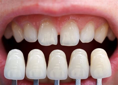 Dental Veneers The Best Way To Close Your Teeths Gaps