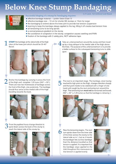 Exclusive Physiotherapy Guide For Physiotherapists Stump Bandaging For