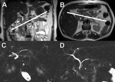 Mr Imaging Of The Pancreas A Pictorial Tour Radiographics