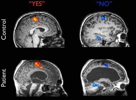 Revista portuguesa de medicina intensiva 1998; muerte cerebral: IMAGENES "MUERTE CEREBRAL"