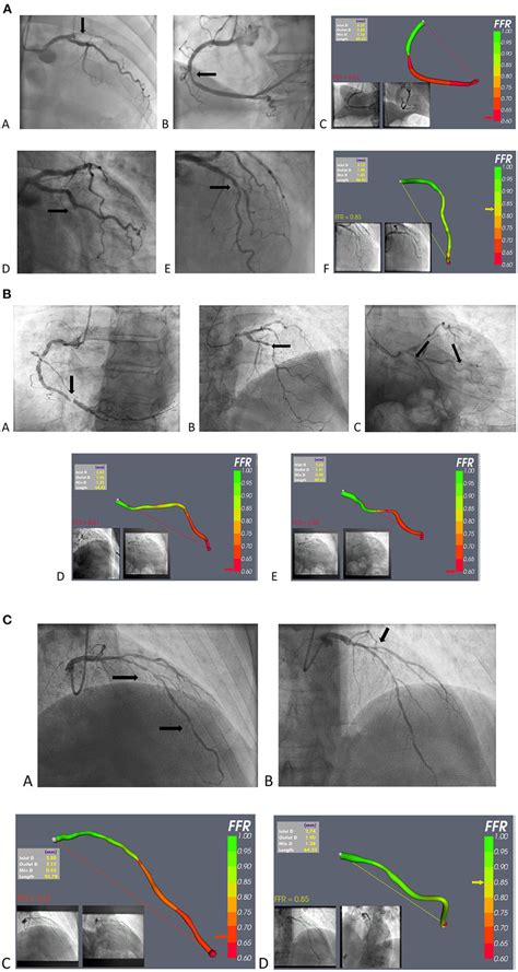 A Example Of Vffr Application In Stemi A C A Case Of Anterior