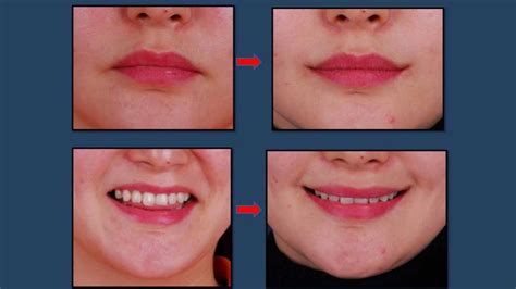 Cosmetic Surgery Procedure Time Plastic Surgery Lip Piercing Falso