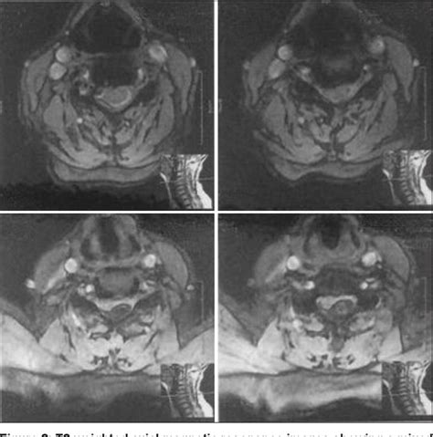 Figure 2 From Spontaneous Cervical Epidural Hematoma With Stroke