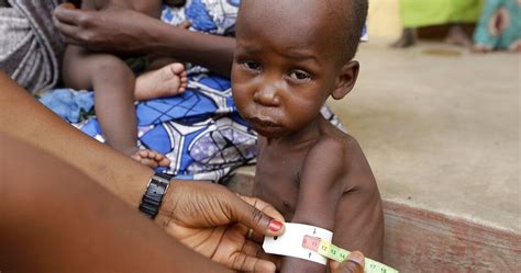 Un Appeal For Funds To Save 30 Million Malnourished Children
