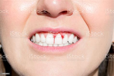 Woman Mouth With Bleeding Gums Periodontal Disease Stock Photo