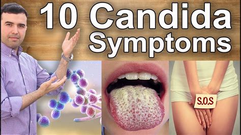 Signs And Symptoms You Have Candidiasis 10 Important Candida