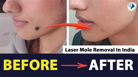 Laser Mole Removal Surgery Before After Essence Cosmetic Surgery Dr