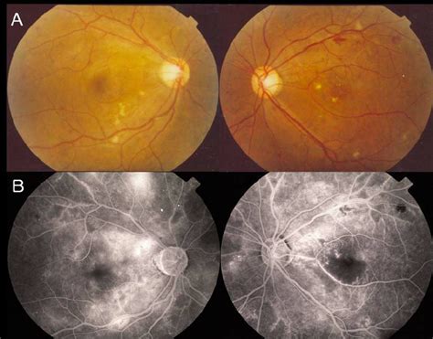 Fundus Photographs And Fluorescein Angiographs At 4 Months After The