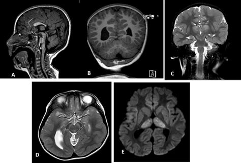 Brain Mri Of The Patient With Slc16a1 Gene Mutation Causing