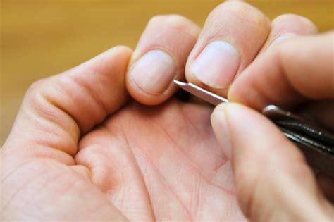 How To Get Rid Of Common Warts Under The Nails