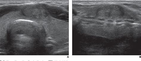 Papillary Thyroid Cancer Ultrasound