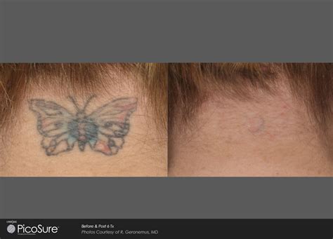 Does laser tattoo removal leave scars? Laser Ink - PicoSure Laser Tattoo Removal Specialists ...