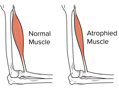 Arm Muscle Atrophy