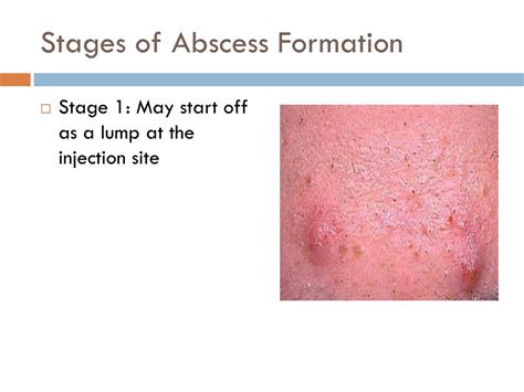 Ppt Abscess Prevention And Management Powerpoint Presentation Free