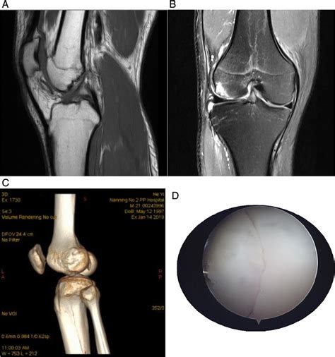 Treatment Of Osteochondral Fracture Of The Lateral Femoral Condyle With Sexiz Pix