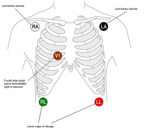 Cardiac Monitor 5 Lead Telemetry Placement