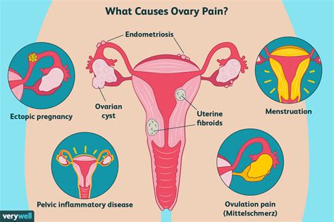 Ovary Pain Causes Treatment And When To See A Healthcare Provider