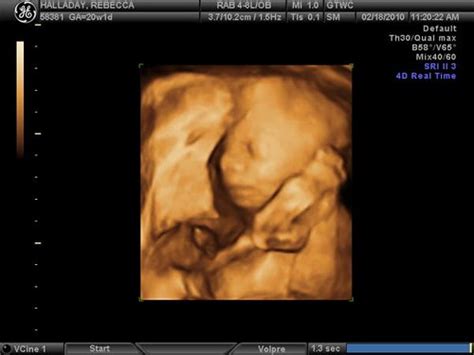 20 Weeks Ultrasound Photo Submitted By Babies Online Membe Flickr