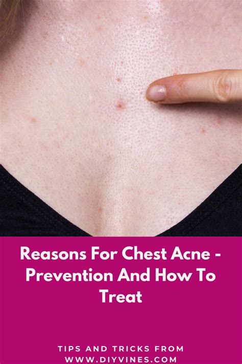 Reasons For Chest Acne Prevention And How To Treat Chest Acne