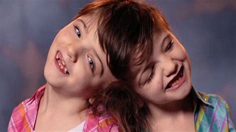 Inspirational Tale Of Conjoined Twins Who Will Share Sight Taste And
