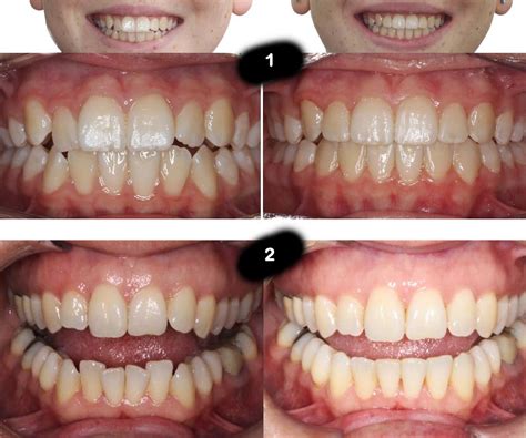 Spark Vs Invisalign The Best Clear Aligners Compared