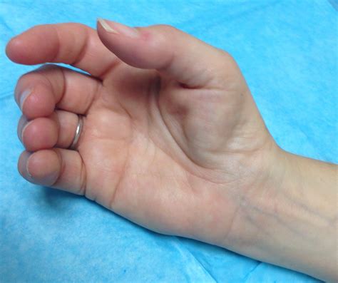 Thenar Muscle Atrophy Hand Surgery Resource