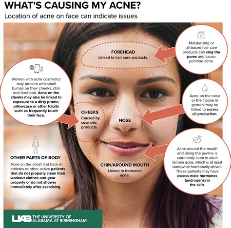 Acne Face Map What Are Your Breakouts Telling You Vlrengbr