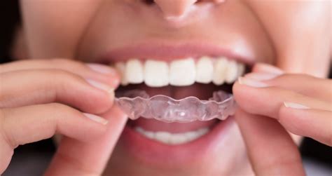 Tips For Cleaning Your Retainer