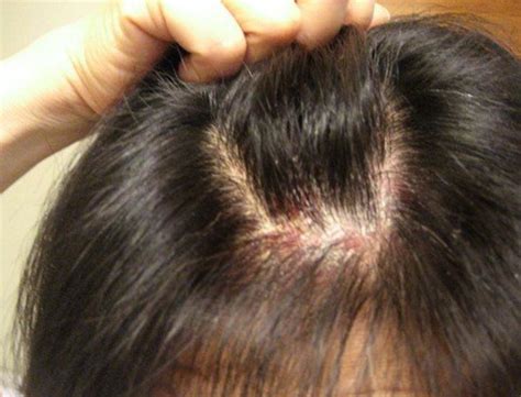 Itchy Scalp Symptoms Hair Loss Causes Treatment Hubpages