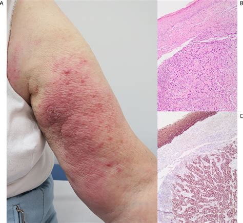 Lymphangitis Carcinomatosa Of A Cutaneous Squamous Cell Carcinoma Bmj