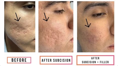 Subcision Filler For Acne Scars Youtube