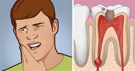 Here Are 5 Natural Ways For Instant Relief From A Toothache My