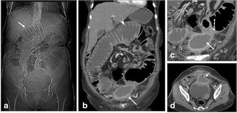 Mind The Gap Imaging Spectrum Of Abdominal Ventral Hernia Repair