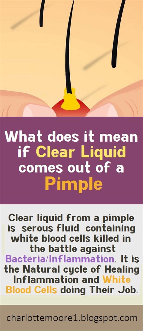 What Does It Mean If Clear Liquid Comes Out Of A Pimple Charlotte Moore