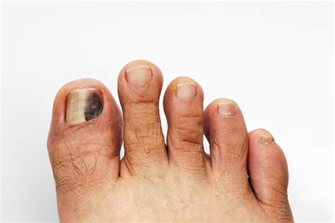 Black Spot On Toenail Learn About Its Development And Treatment