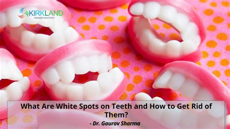 What Are White Spots On Teeth And How To Get Rid Of Them Kirkland